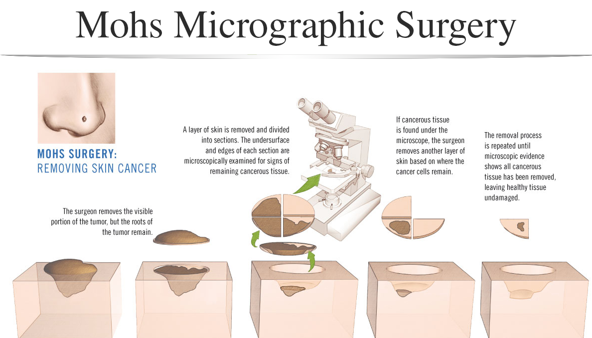 mohs-surgery-large1